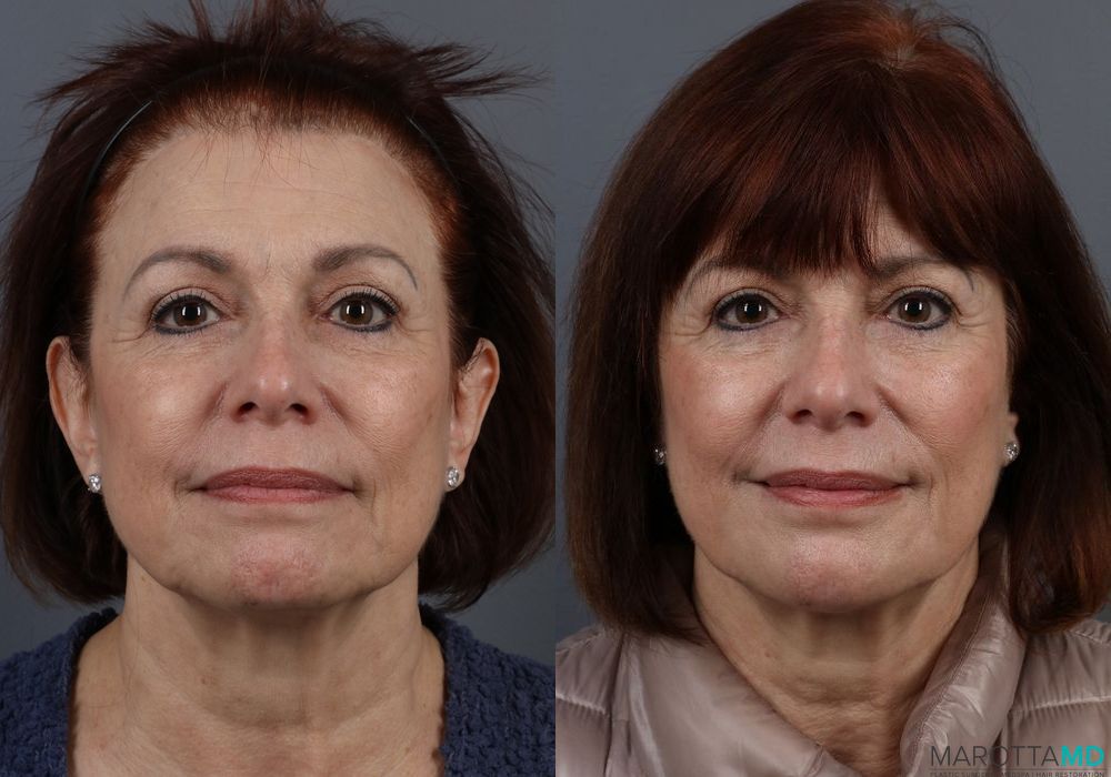BOTOX® Cosmetic - Case 379