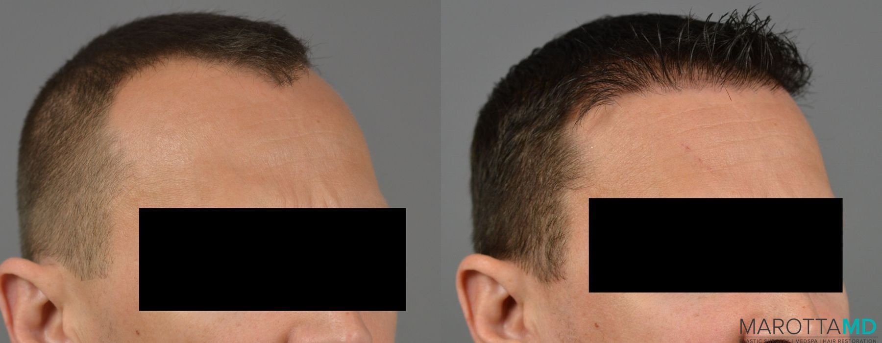 Hair Transplantation - Thumbnail 2