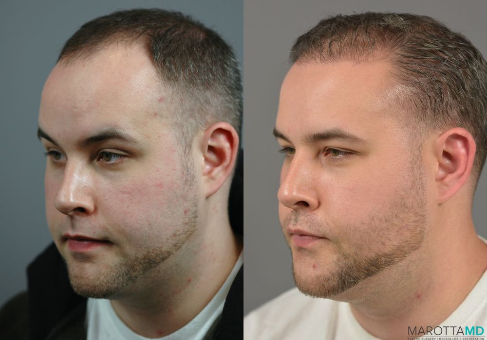 Hair Transplantation - Thumbnail 2