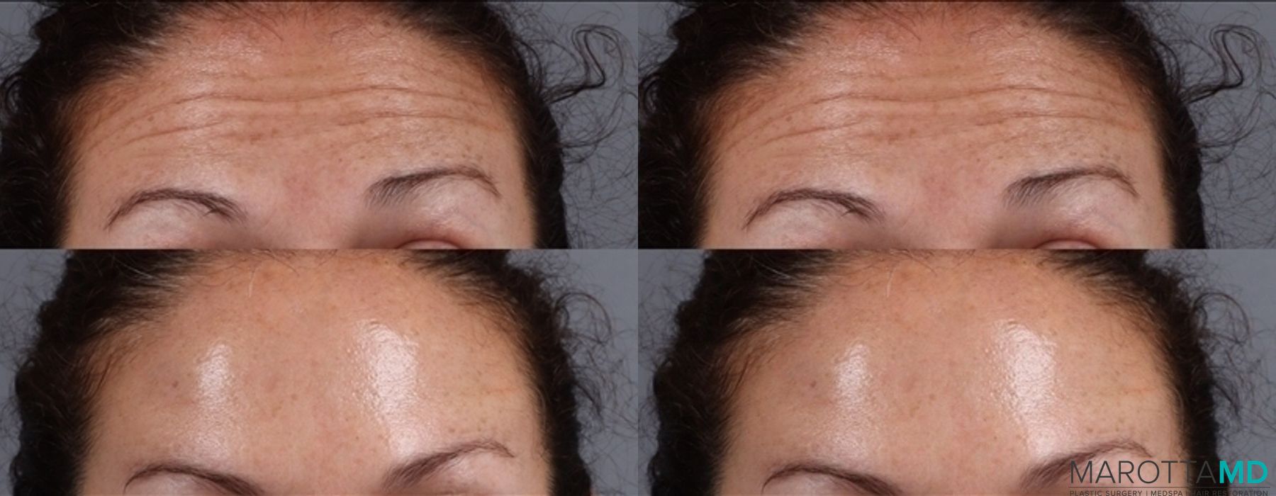 Before and after Botox - Forehead case 7186 - Angle 2