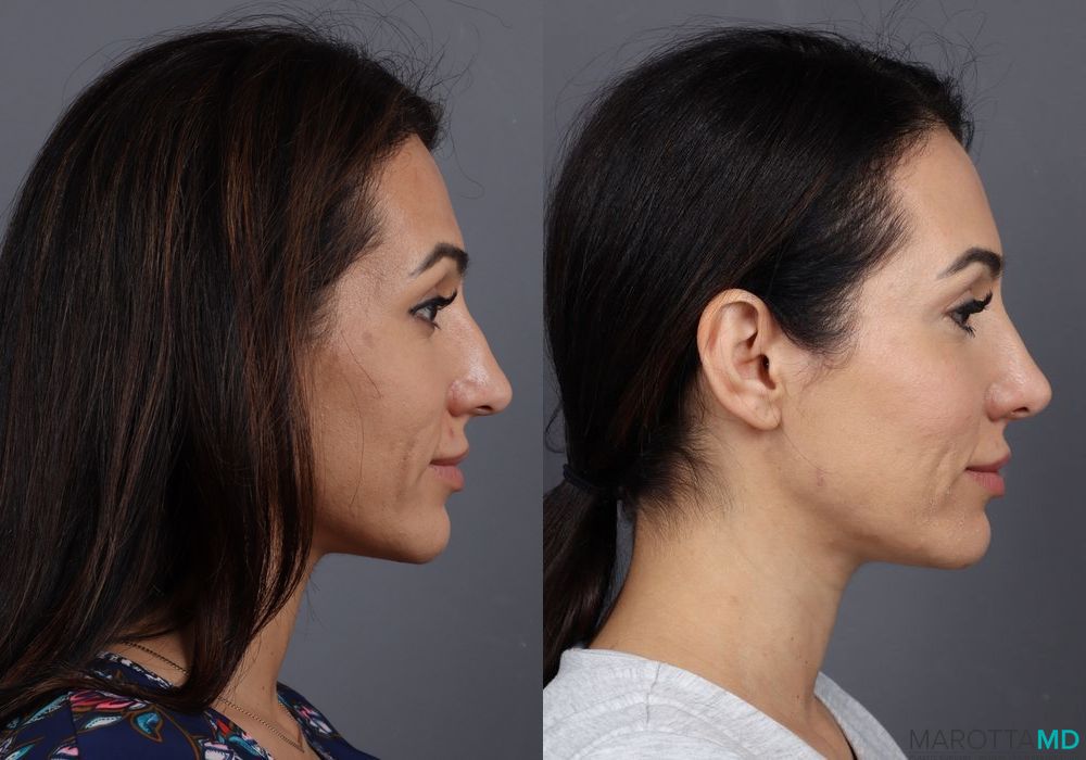 Botox - Crow's Feet - Case 308