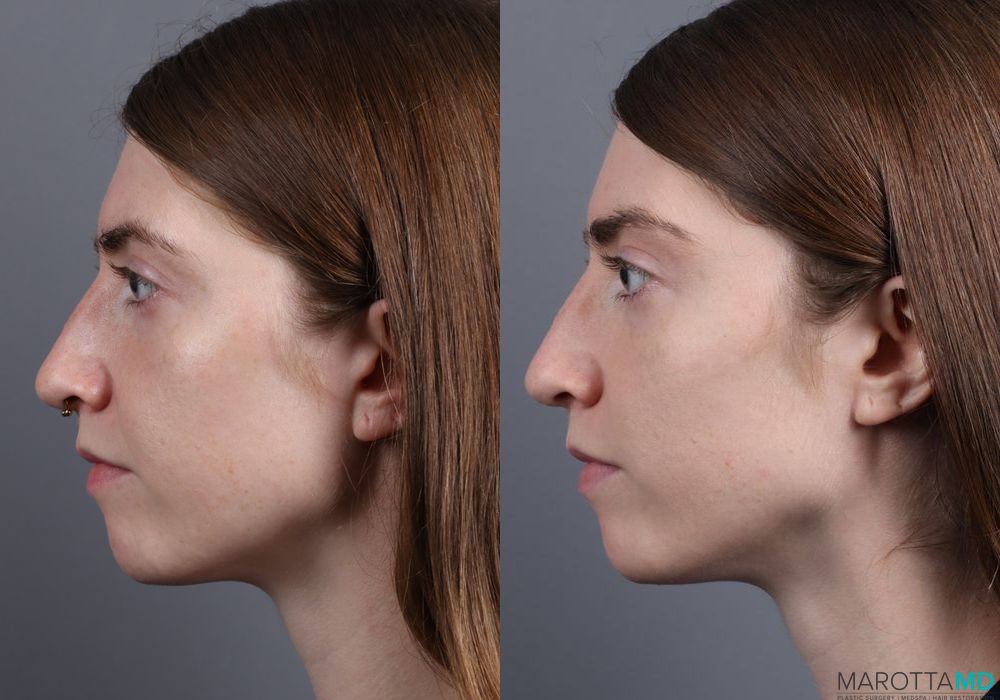 Juvederm / Fillers - Thumbnail 3
