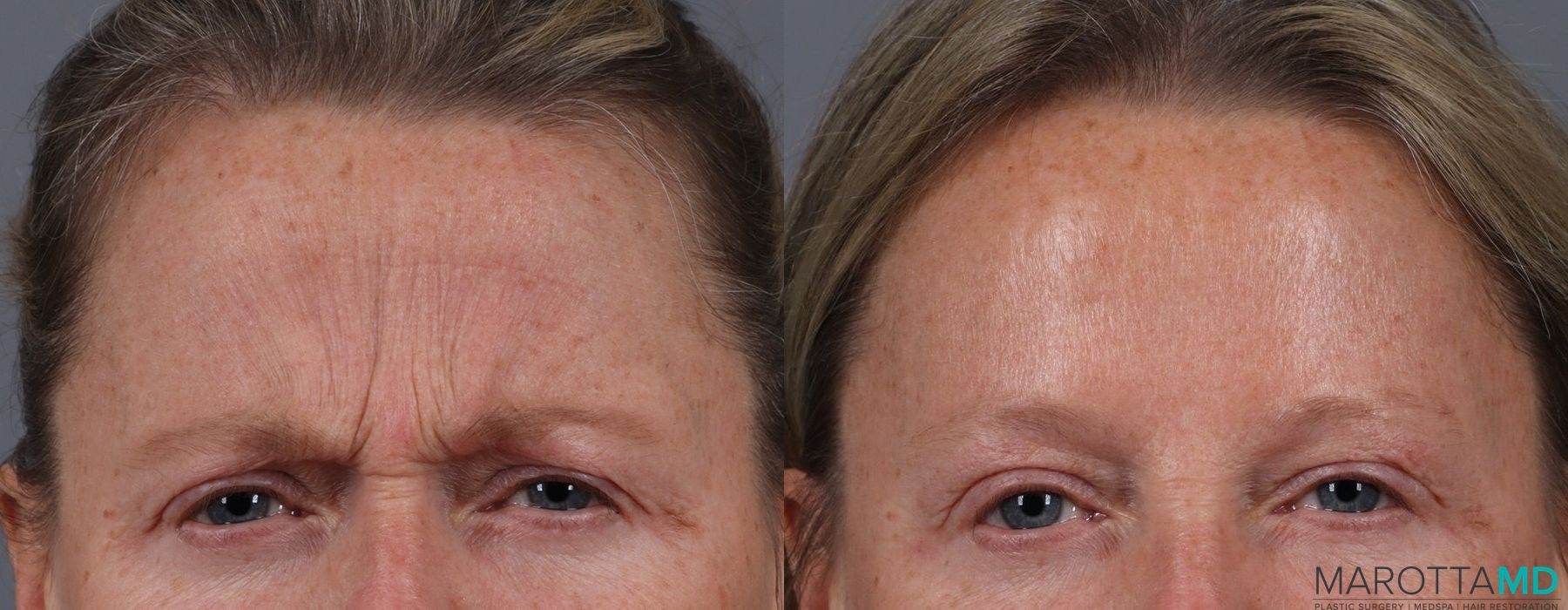 Before and after Botox - Forehead case 7128 - Angle 2