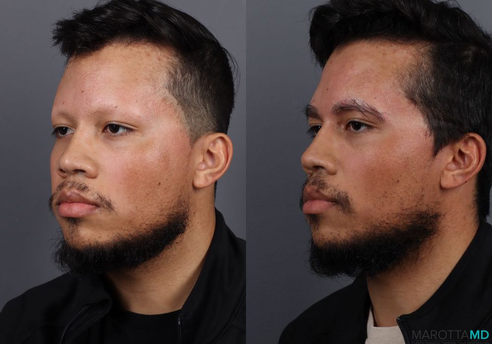 Hair Transplantation - Thumbnail 3