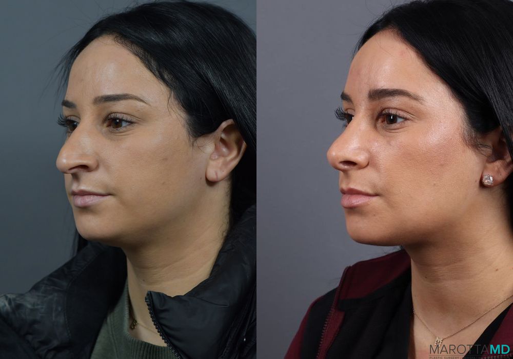 Before and after Rhinoplasty case 7229 - Angle 2