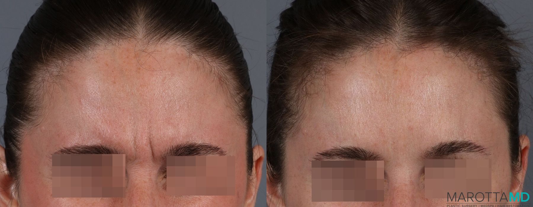 Before and after Botox - Glabella case 7188 - Angle 2
