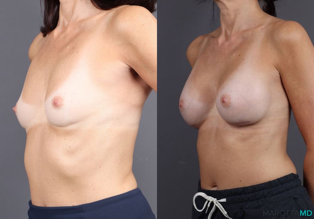 Breast Augmentation - Thumbnail 2