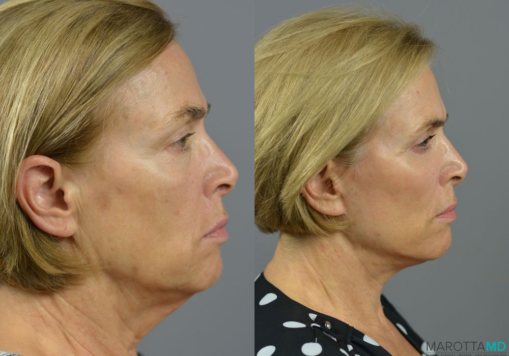 Facelift & Neck Lift - Thumbnail 2