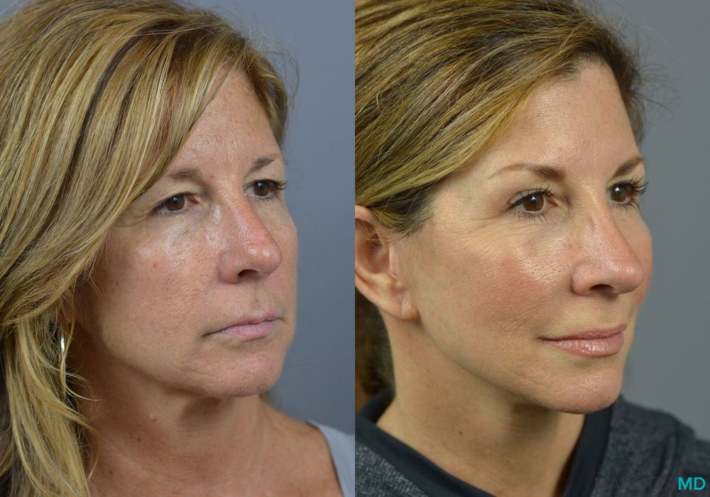 Before and after Rhinoplasty case 7254 - Angle 2