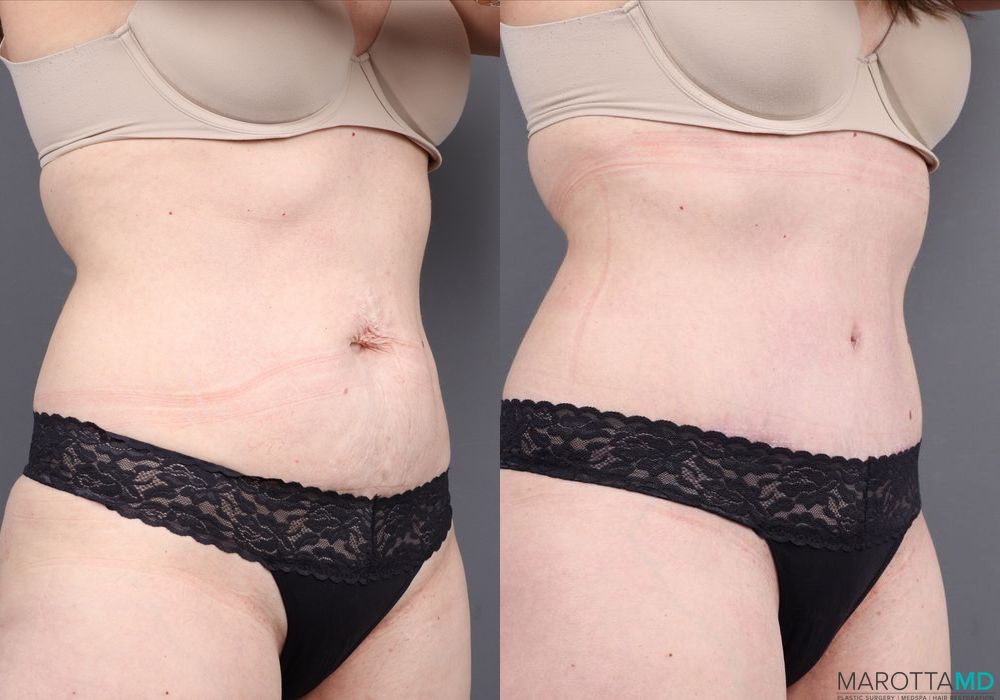 Abdominoplasty - Case 114