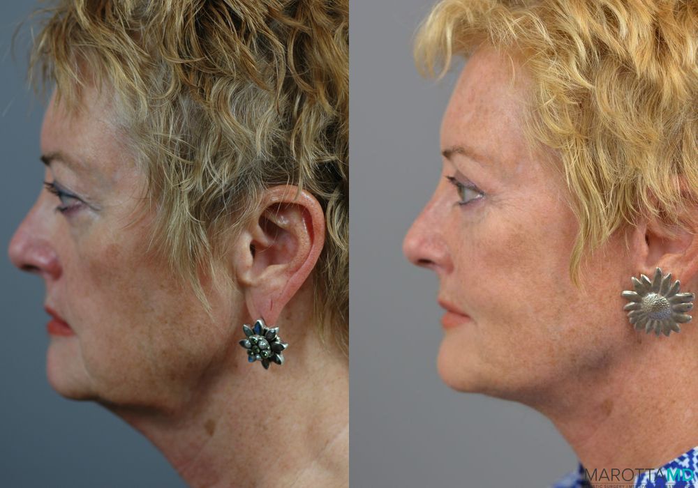 Facelift & Neck Lift - Thumbnail 4