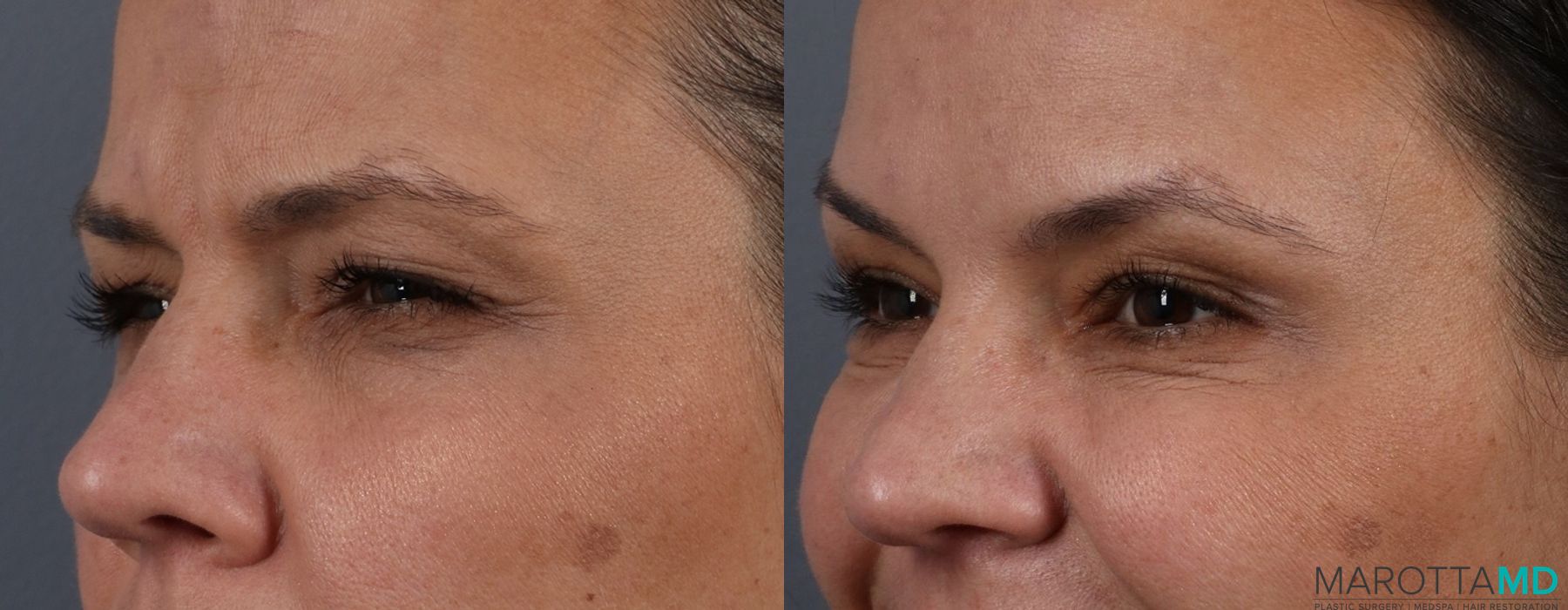Before and after BOTOX® Cosmetic case 7306 - Angle 5