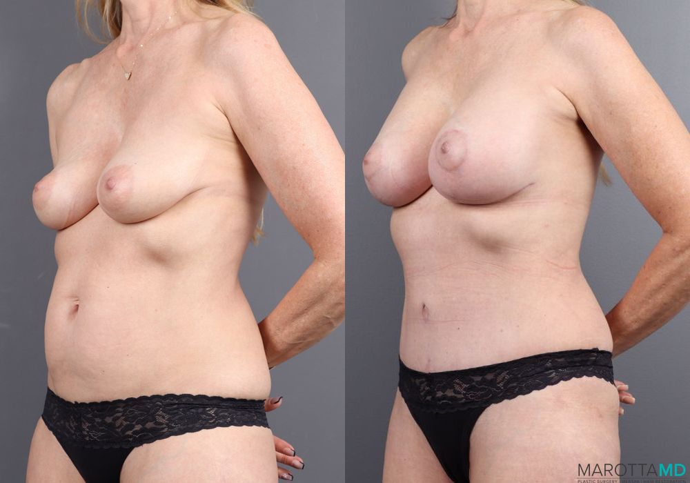 Before and after Abdominoplasty case 7307 - Angle 3