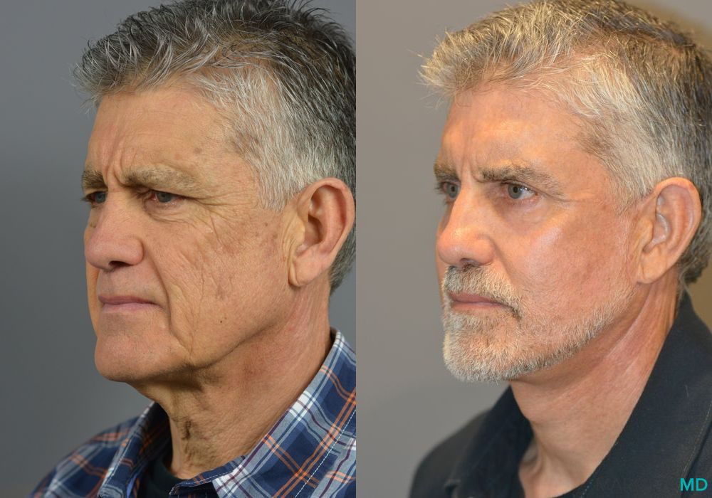 Laser Skin Resurfacing - Face - Thumbnail 2