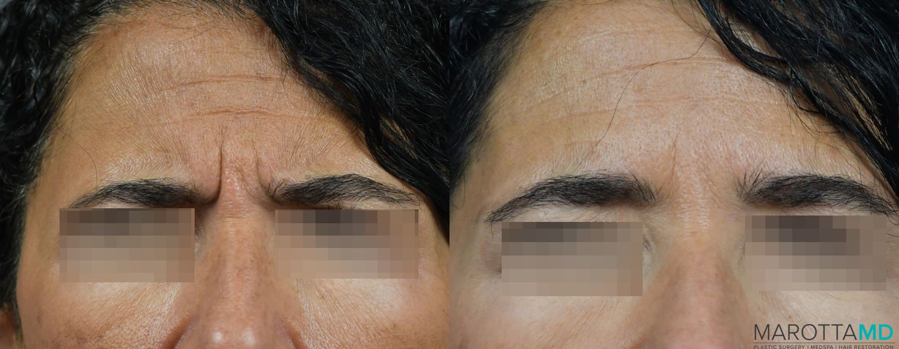 Before and after Botox - Glabella case 7176