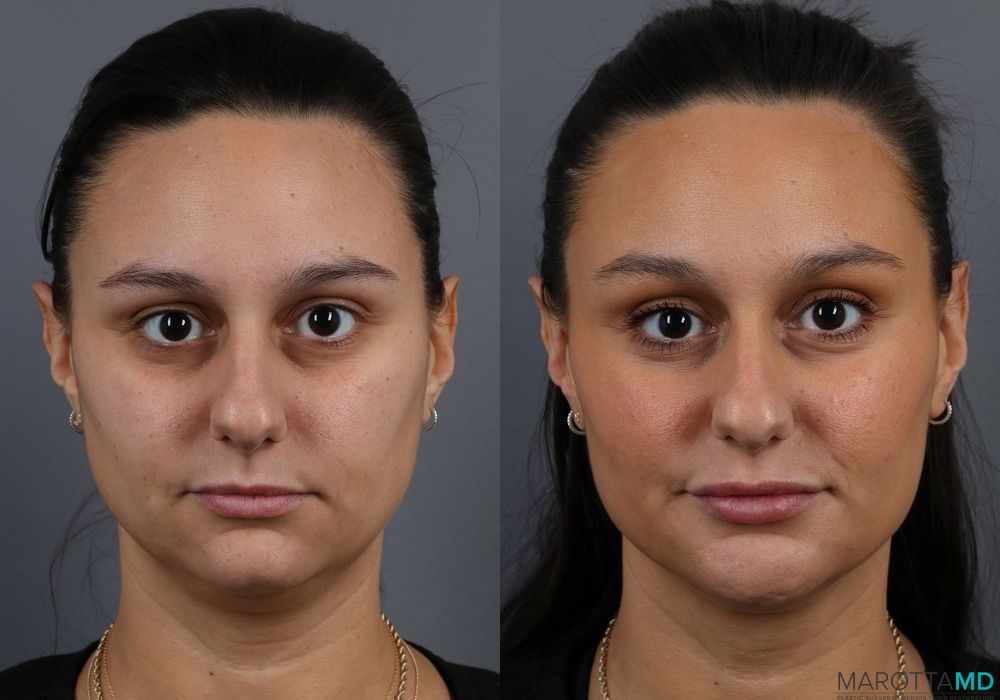 Before and after Filler - Jawline case 7213