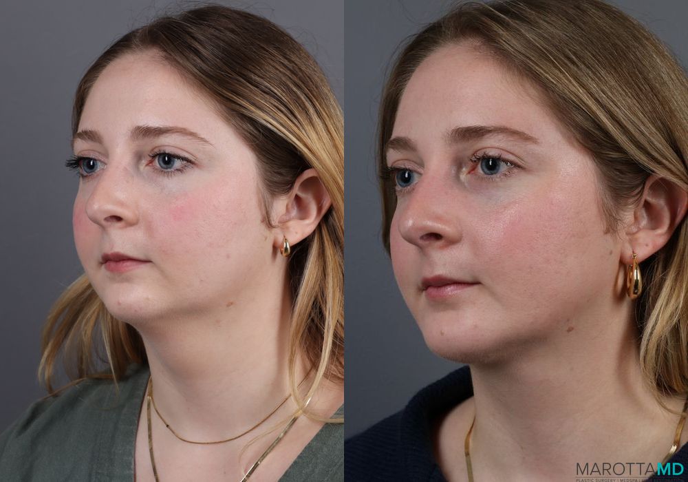 Liposuction of the Neck - Case 229