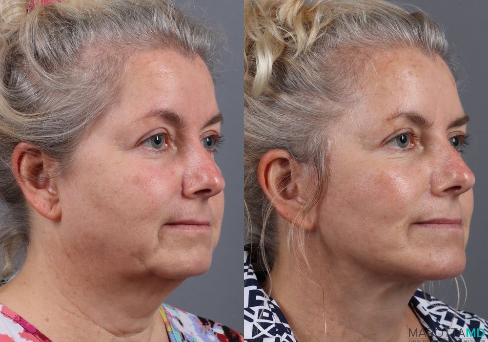 Facelift & Neck Lift - Thumbnail 5