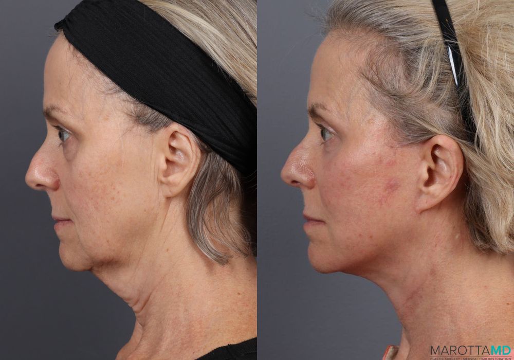 Before and after Facelift & Neck Lift case 7087 - Angle 4