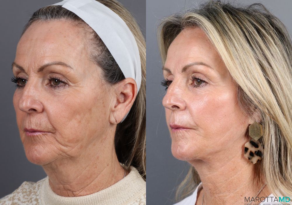 Laser Skin Resurfacing - Face - Thumbnail 2