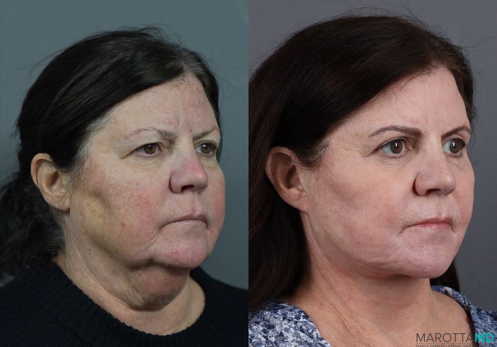 Facelift & Neck Lift - Thumbnail 4