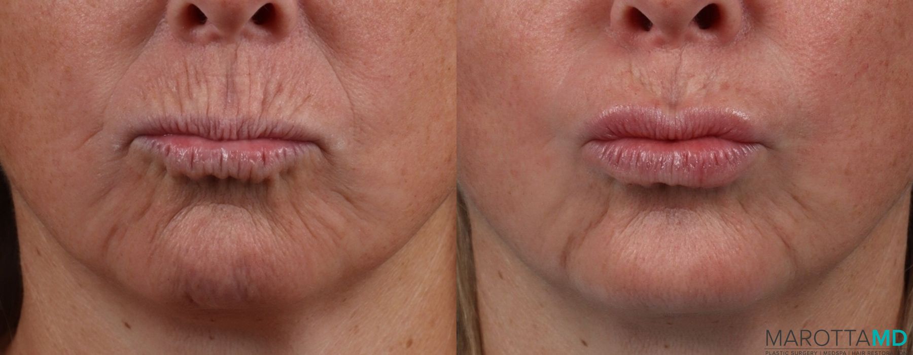 Before and after Botox - Chin case 7130