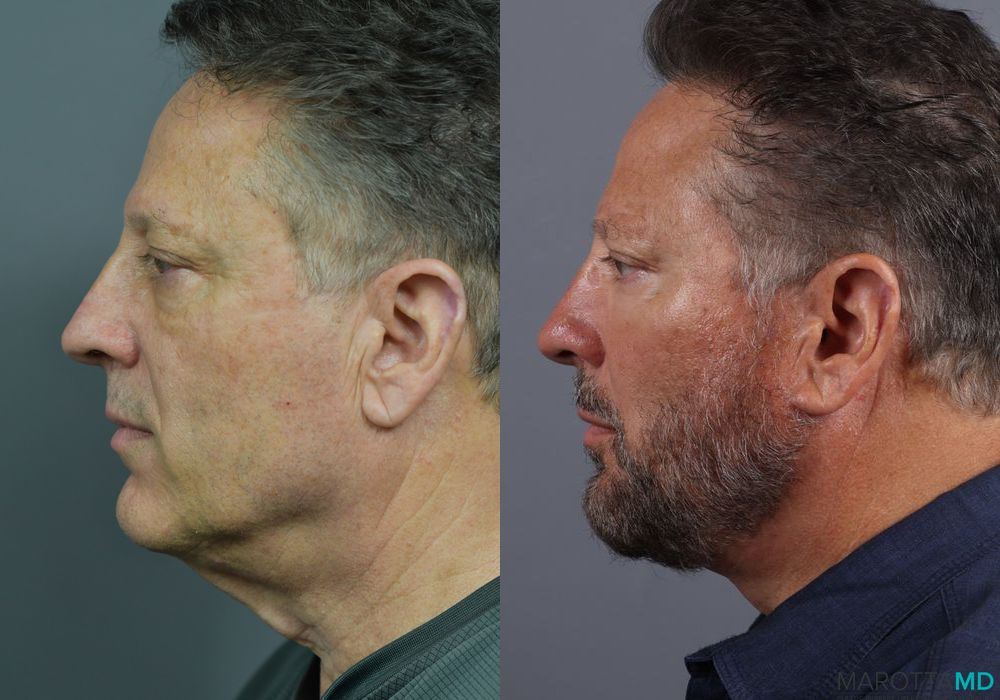 Facelift & Neck Lift - Thumbnail 4