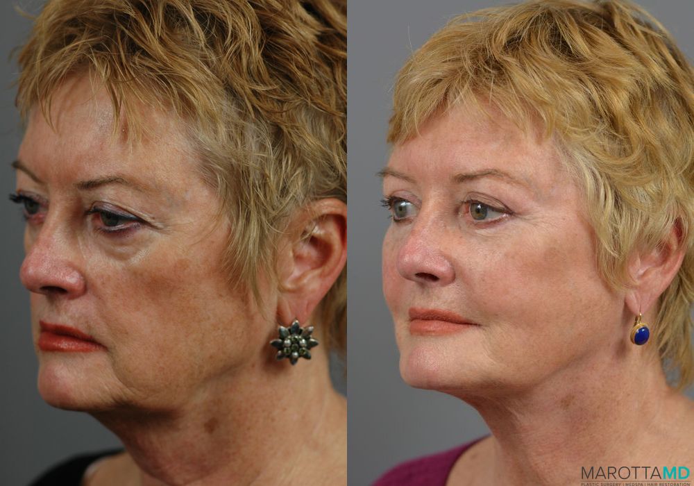 Blepharoplasty - Thumbnail 2