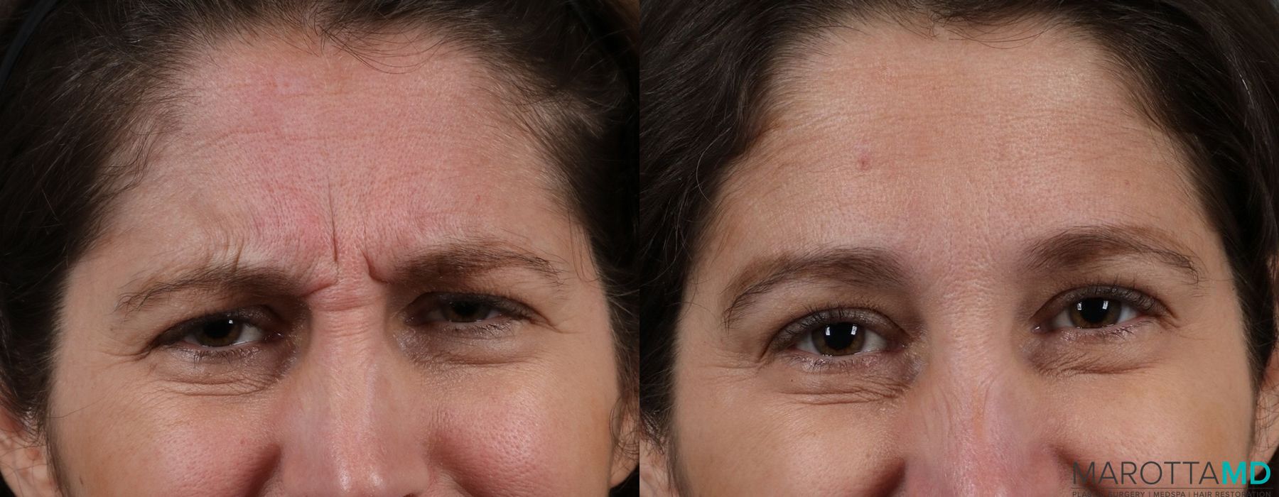Before and after Botox - Crow's Feet case 7167