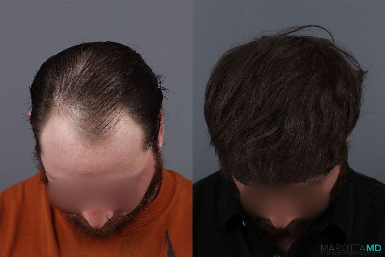 Before and after Hair Transplantation case 26095