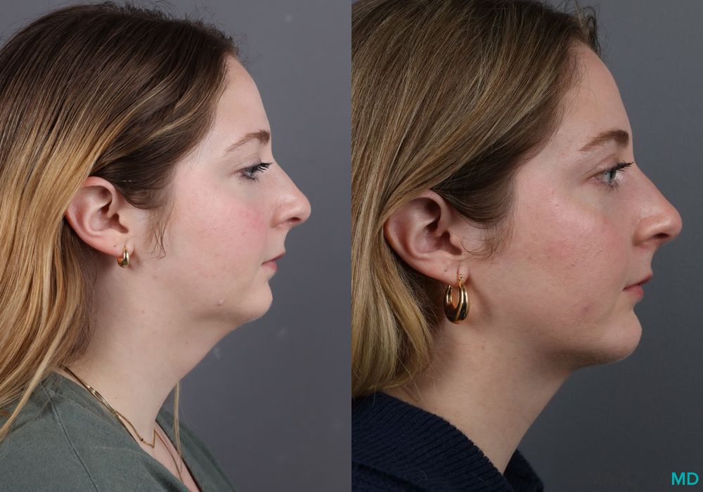 Liposuction of the Neck - Thumbnail 4