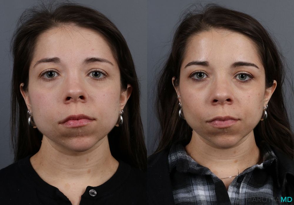 Botox - Forehead - Thumbnail 4