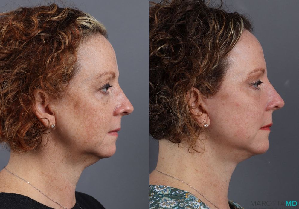 Blepharoplasty - Thumbnail 4