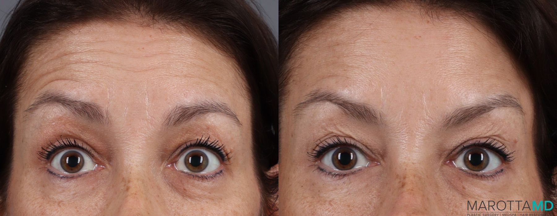 BOTOX® Cosmetic - Thumbnail 2