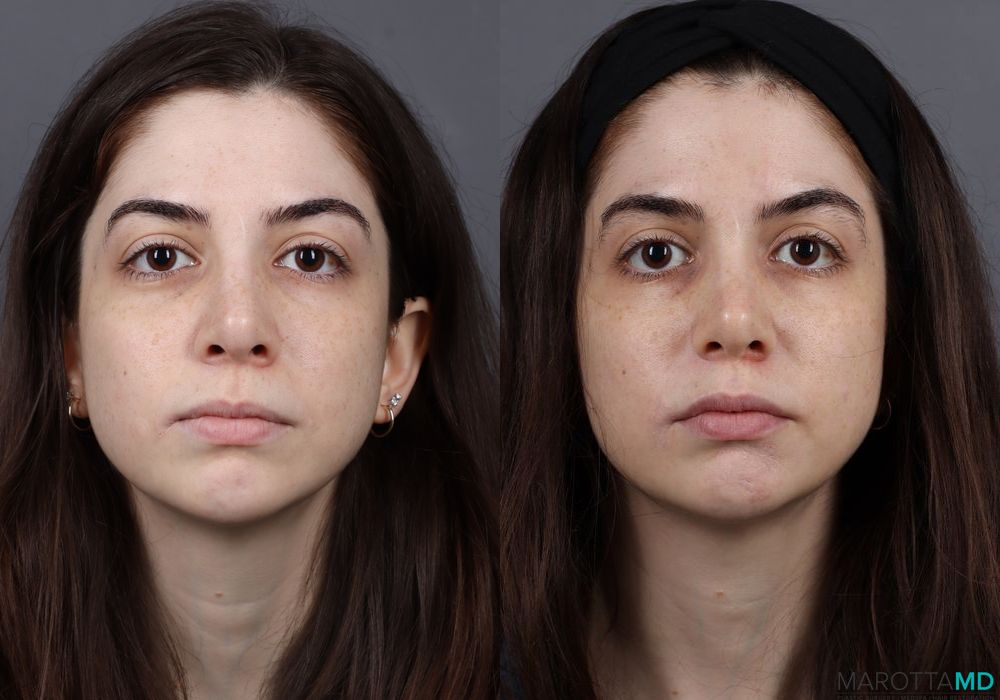 Before and after Botox - Gummy Smile case 7201