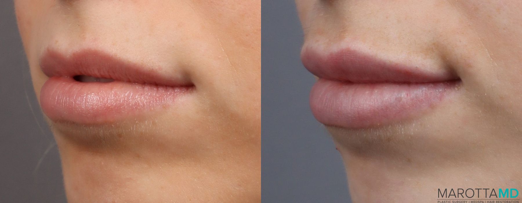 Filler - Lips - Thumbnail 3