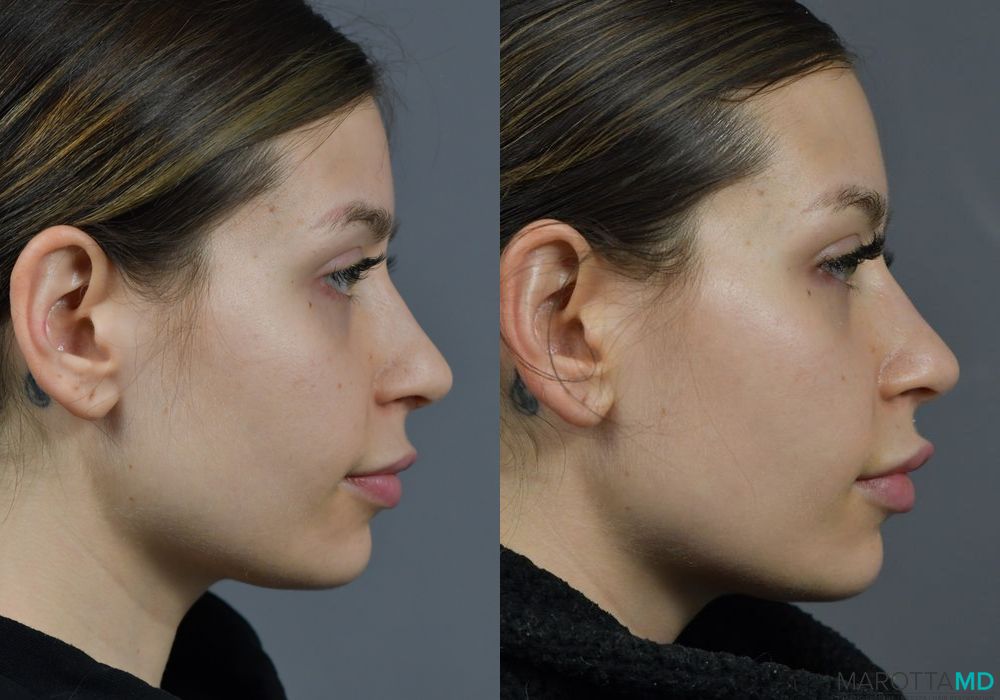 Before and after Botox - Lip Flip case 7289 - Angle 4