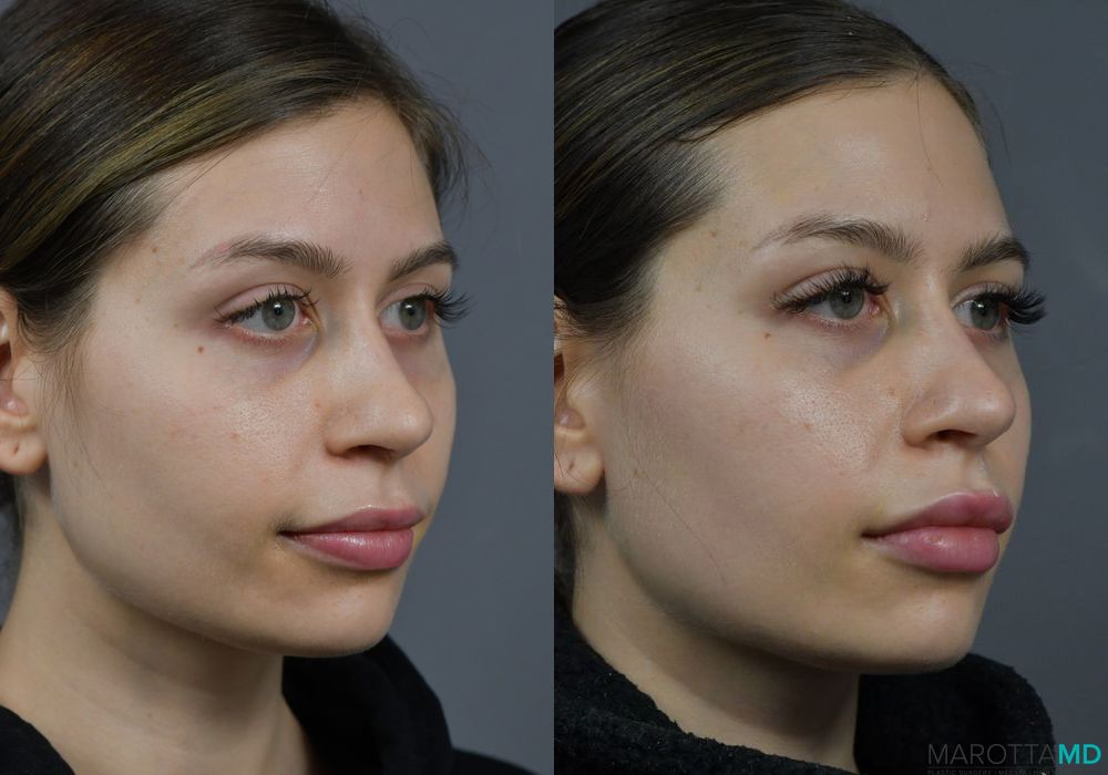 Before and after Filler - Lips case 7212 - Angle 5