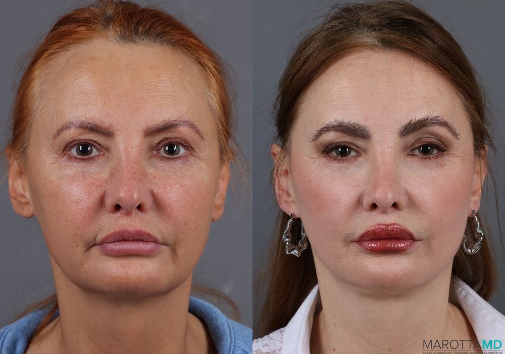 Hair Transplantation - Thumbnail 3