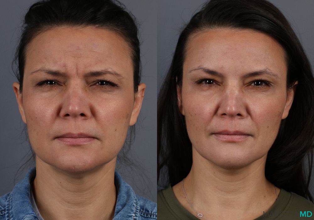 Before and after Botox - DAO case 7162 - Angle 2
