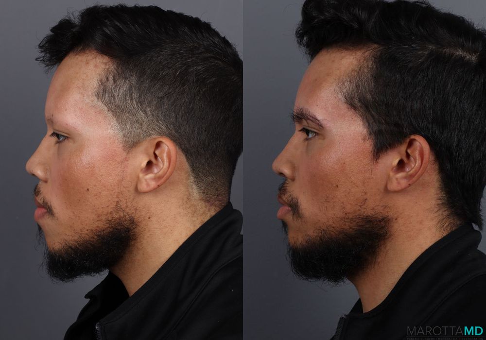 Hair Transplantation - Thumbnail 4