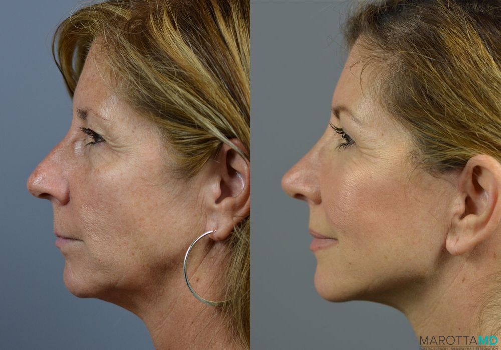 Before and after Mini Facelift case 7036 - Angle 5