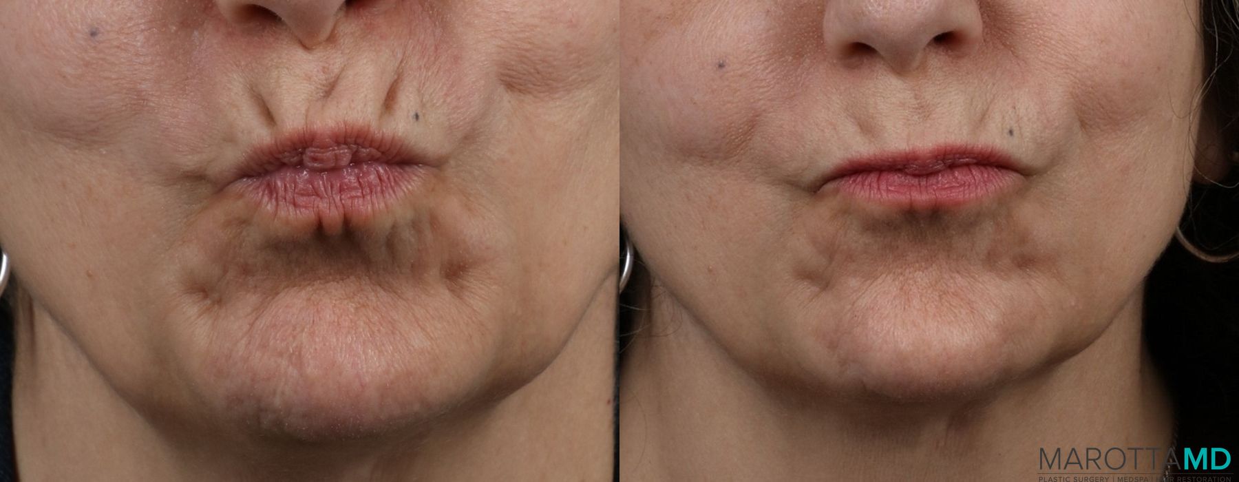 Before and after Botox - Crow's Feet case 7150 - Angle 3