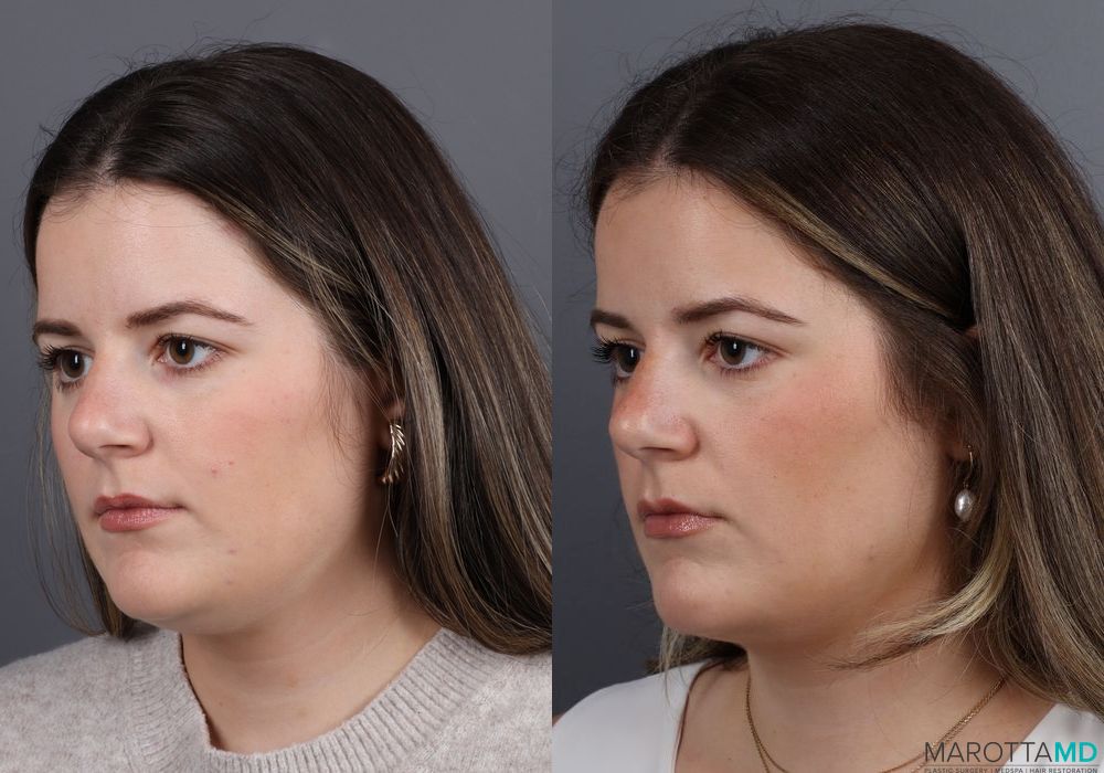 Before and after Liposuction of the Neck case 7011 - Angle 4