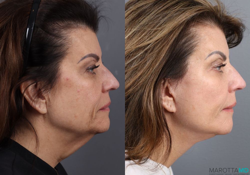Facelift & Neck Lift - Thumbnail 3