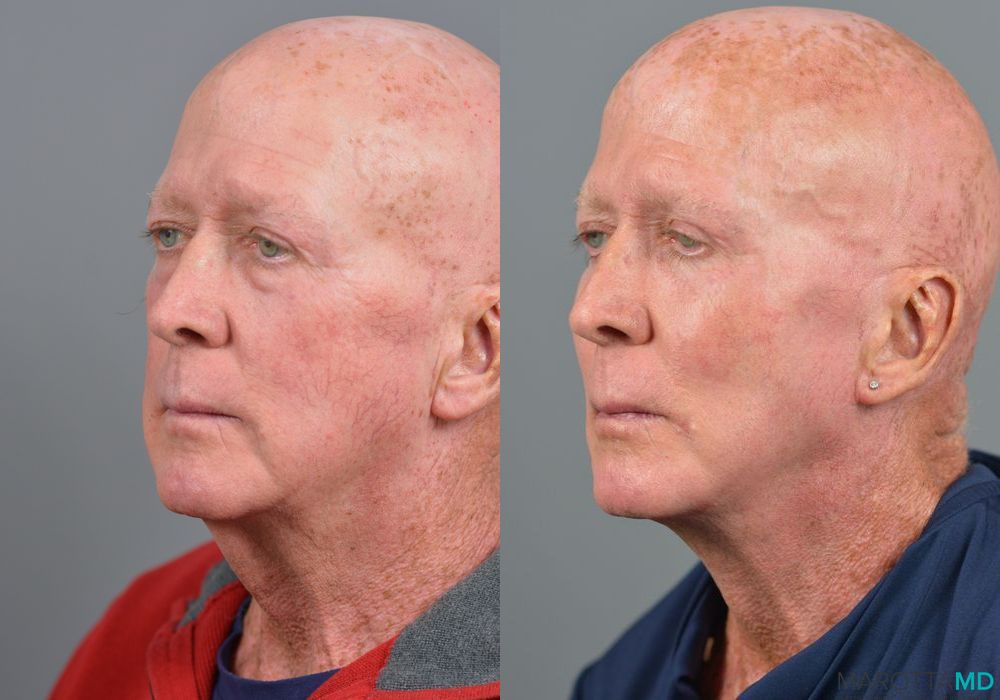 Cheek Augmentation - Case 177