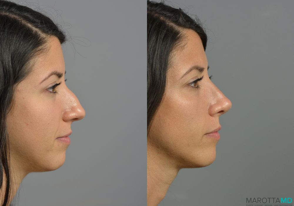 Rhinoplasty - Case 1076
