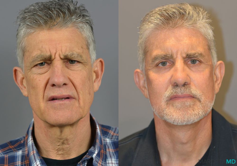 Laser Skin Resurfacing - Face - Case 1026