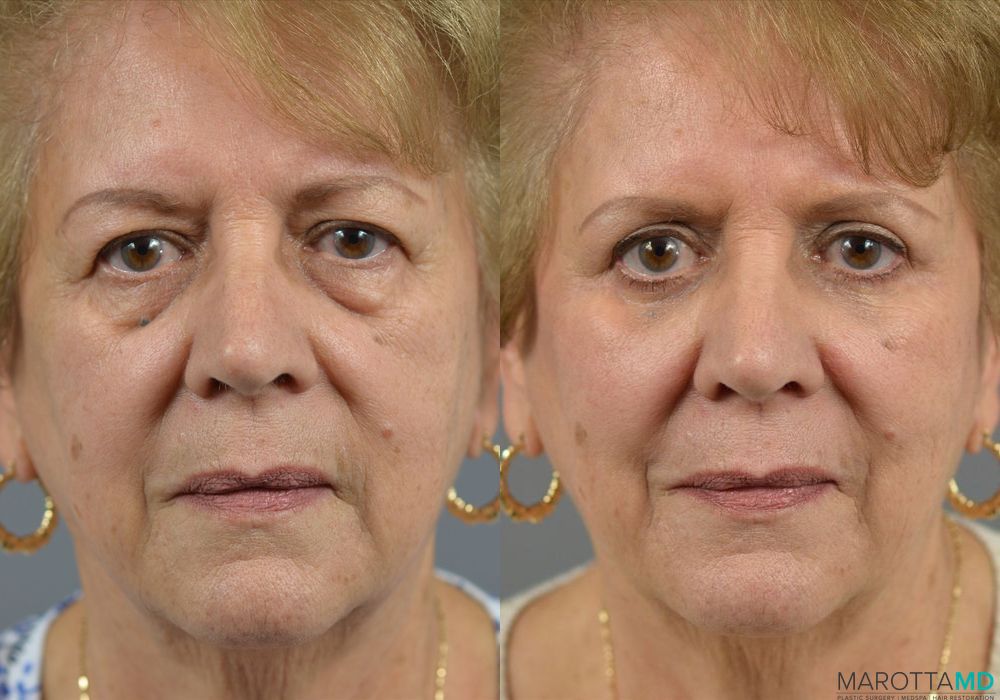 Before and after Blepharoplasty case 7007