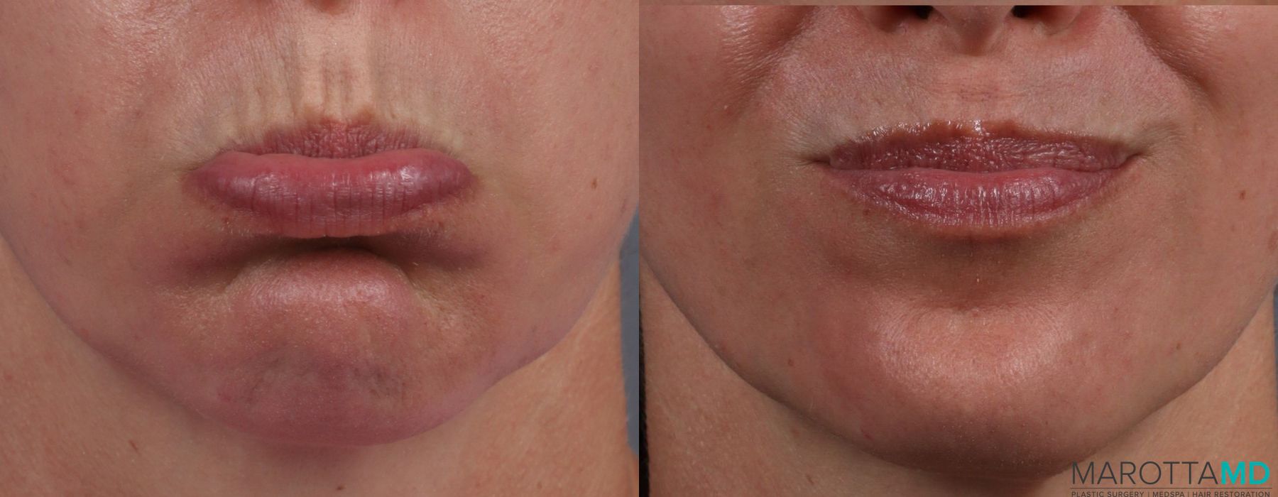 BOTOX® Cosmetic - Case 376